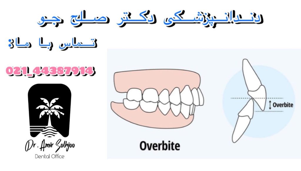 اوور بایت در مال اکلوژن کلاس