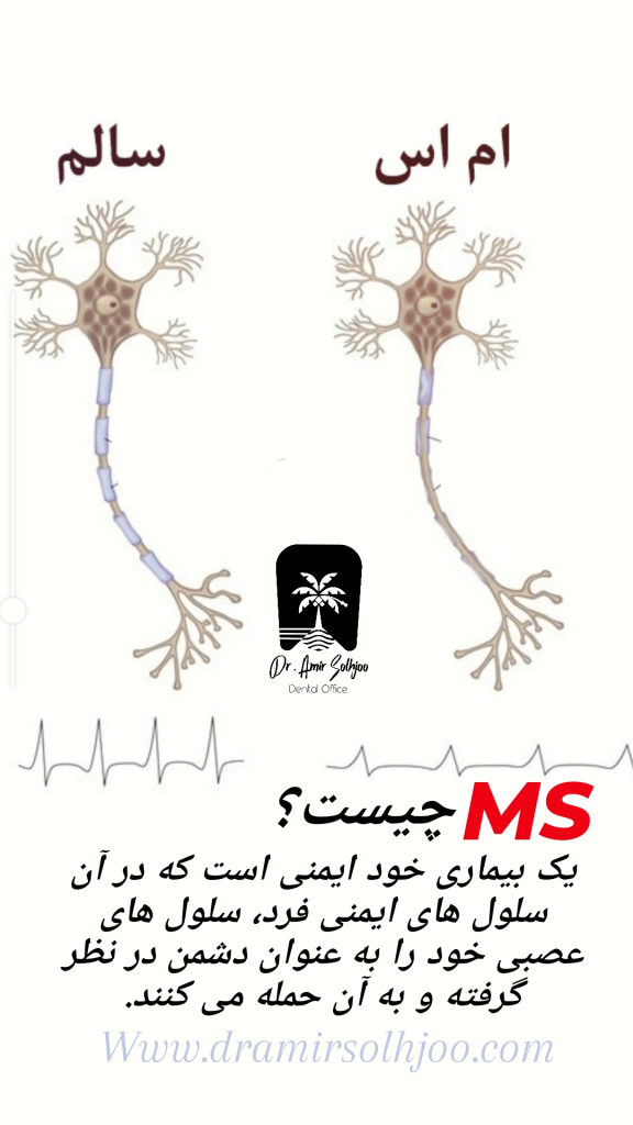 بیماری ام اس و تفاوت سلول سالم و سلول ms