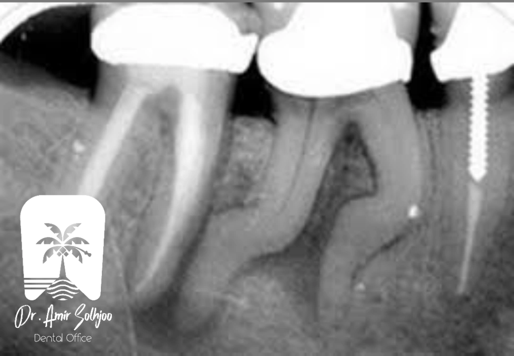 دیلاسریشن(Dilaceration)