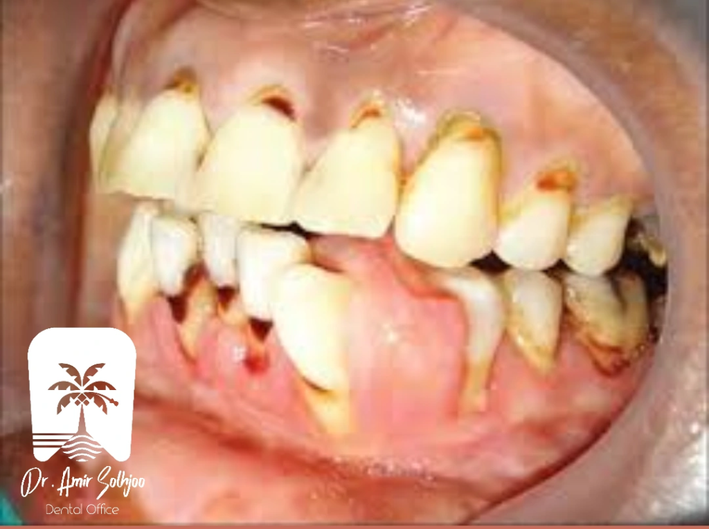 استئومیلیت فک