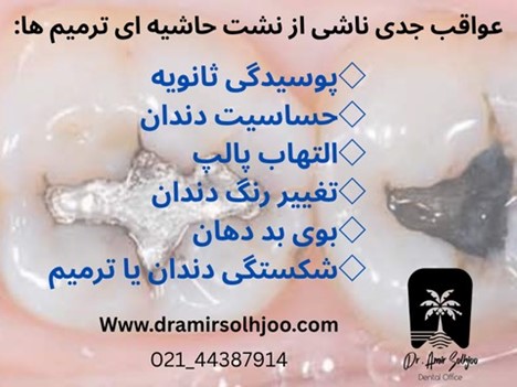 عواقب نشت حاشیه ای ترمیم ها