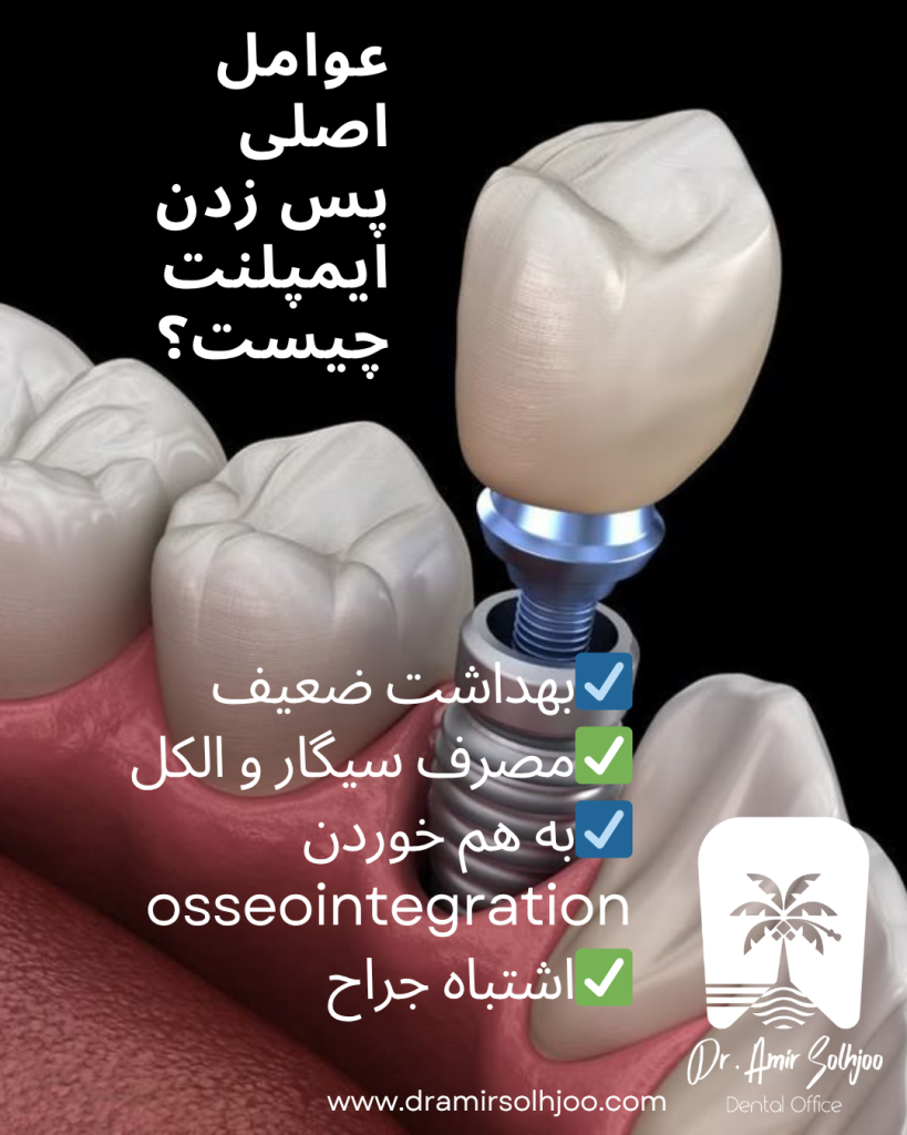 پس زدن ایمپلنت