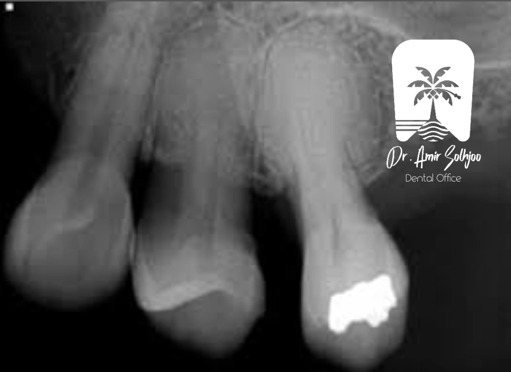 دندان عقل آلوئول