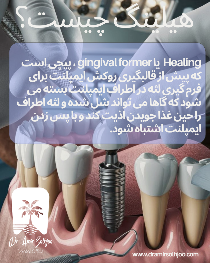 هیلینگ ایمپلنت چیست
