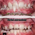 کشیدن سریالی دندان‌ها در ارتودنسی