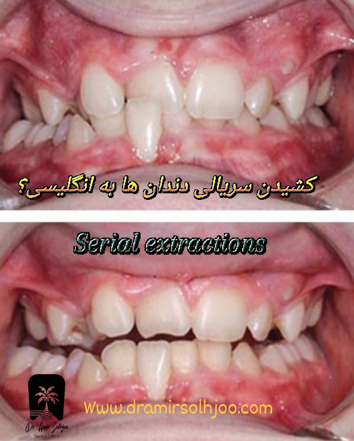 کشیدن سریالی دندانها در ارتودنسی