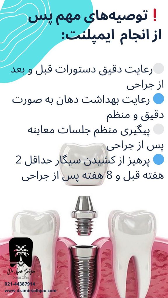 نکات بعد از ایمپلنت