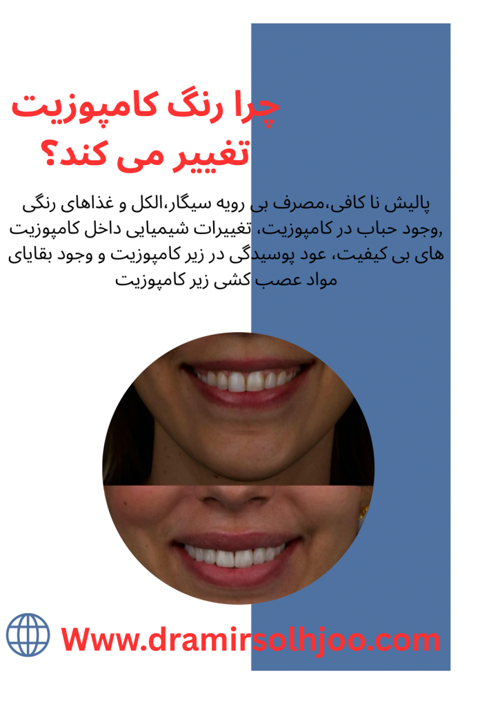 تغییر رنگ کامپوزیت دندان