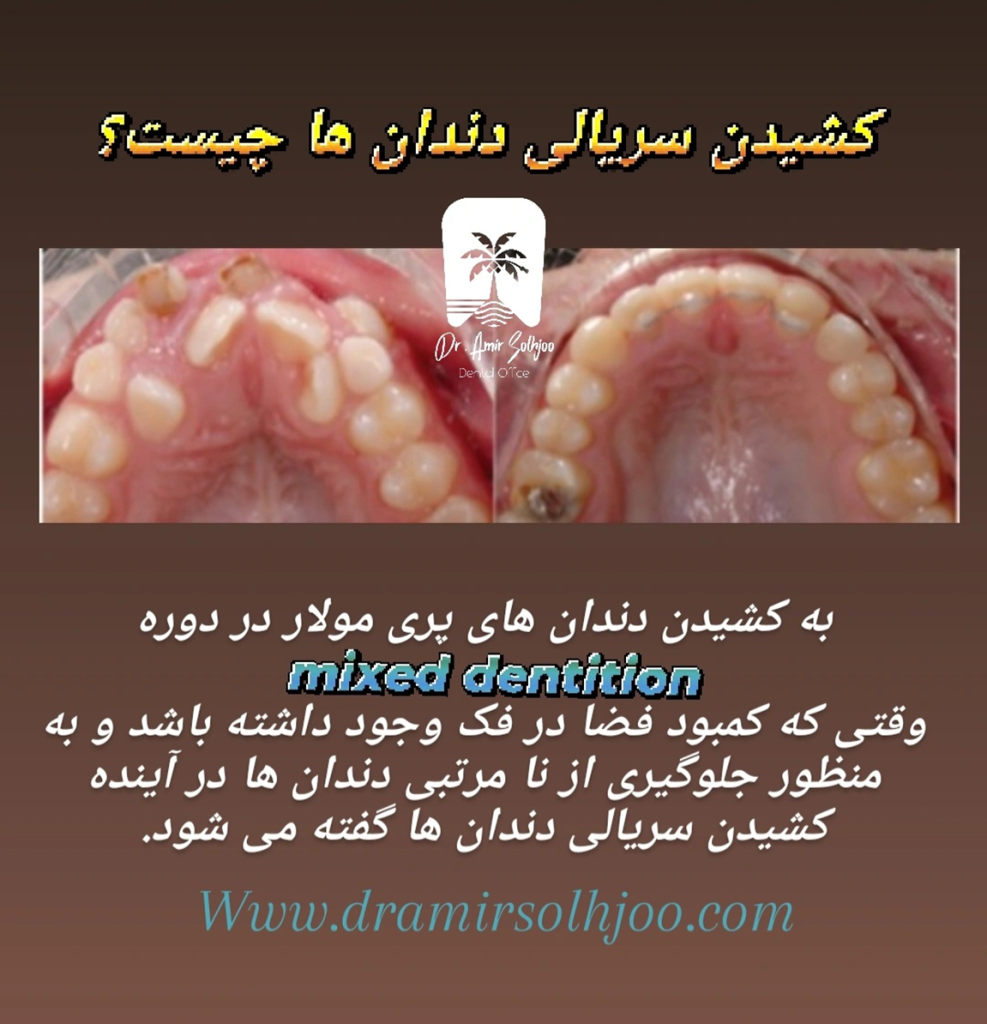 کشیدن سریالی دندانها در ارتودنسی