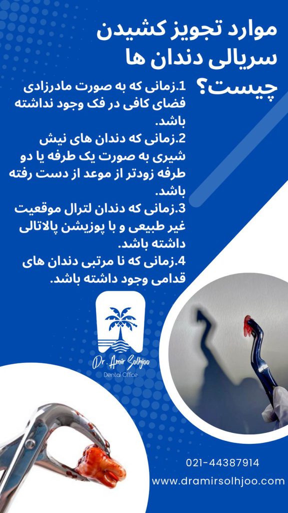 علت کشیدن سریالی دندانها در ارتودنسی