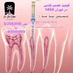 قیمت عصبکشی در تهران