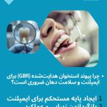 پیوند استخوان هدایت‌شده (GBR)