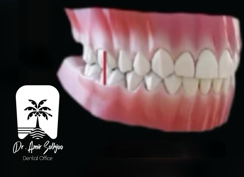 توضیح علمی اکلوژن بالانس