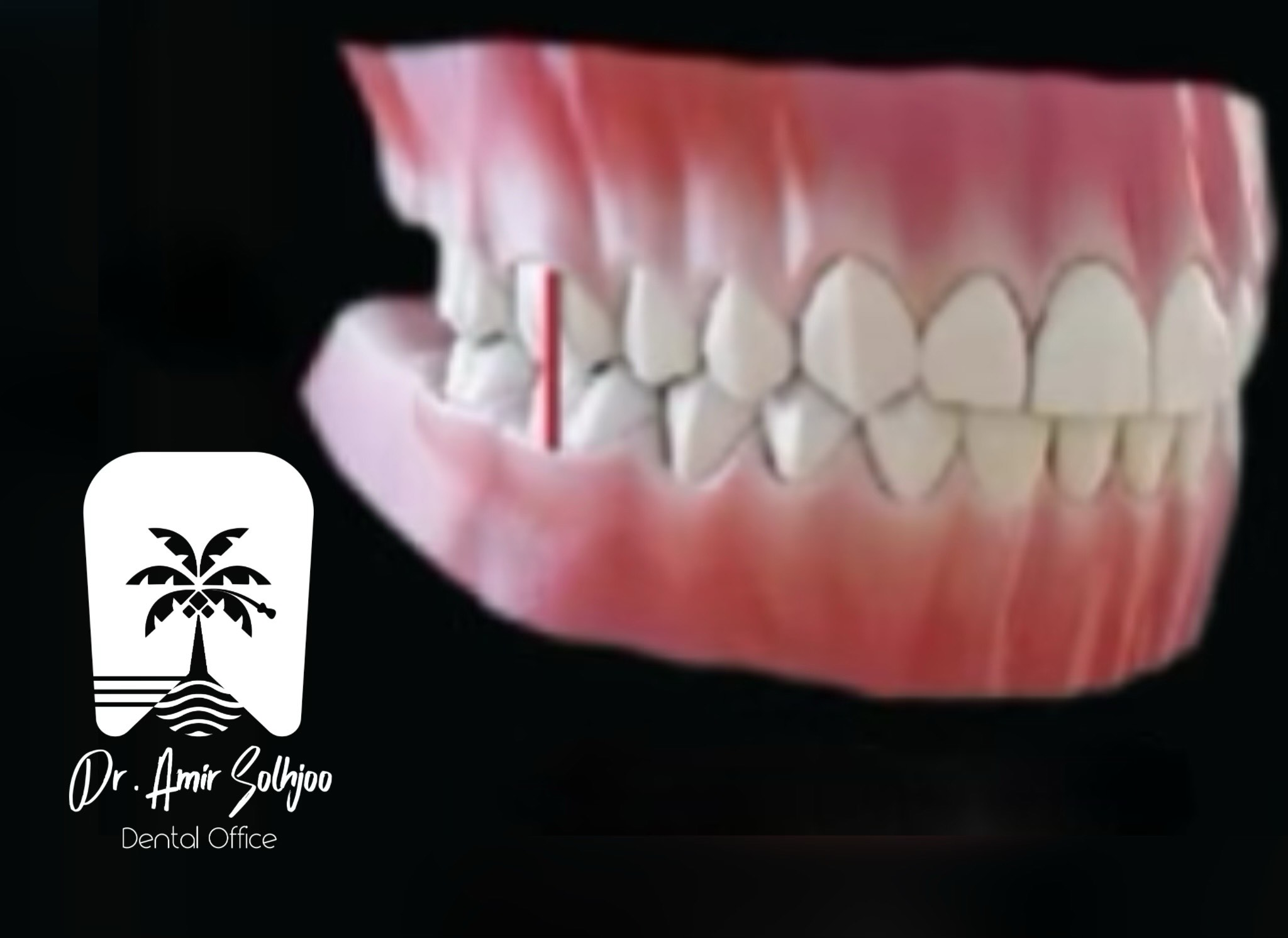 اکلوژن بالانس