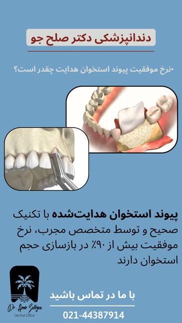 پیوند استخوان هدایتشده و ایمپلنت