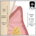 Epithelial Attachment