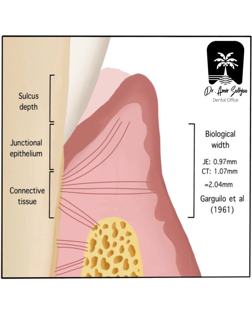 Epithelial Attachment