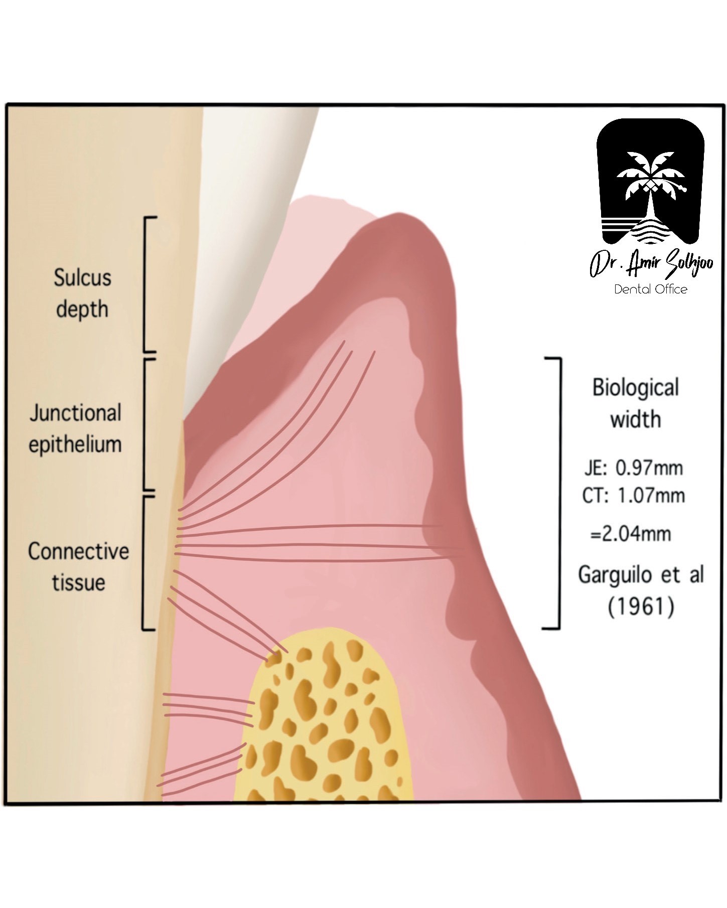 Epithelial Attachment