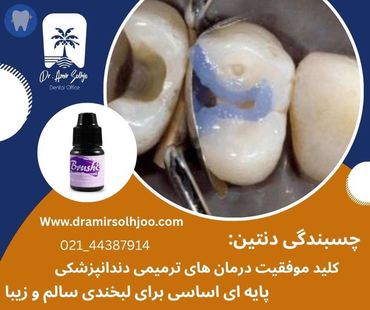 چسبندگی دنتین