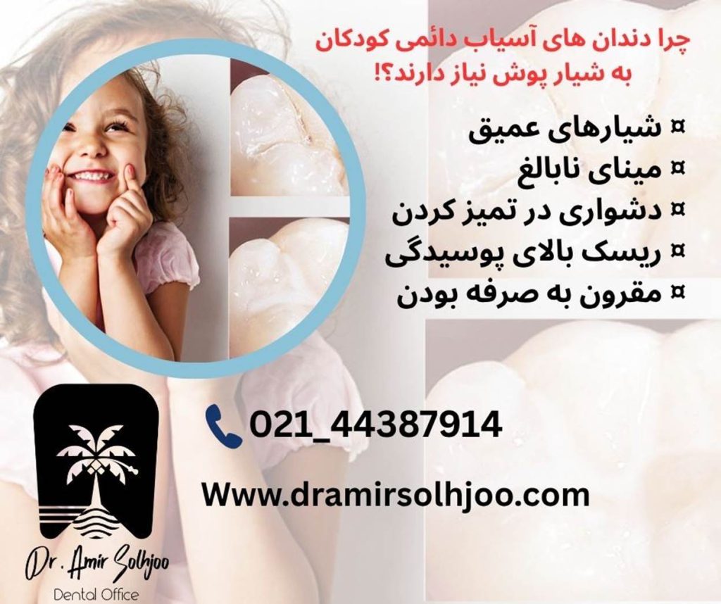 شیار پوش دندان کودکان
