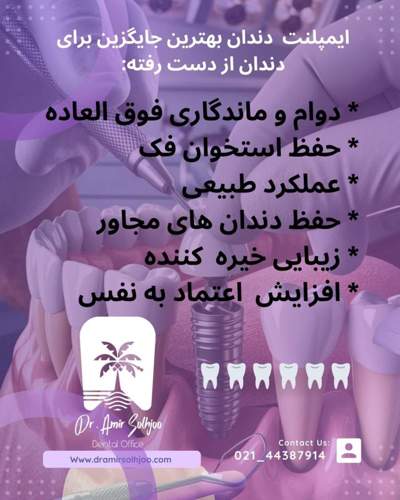 ایمپلنت اقساطی غرب تهران