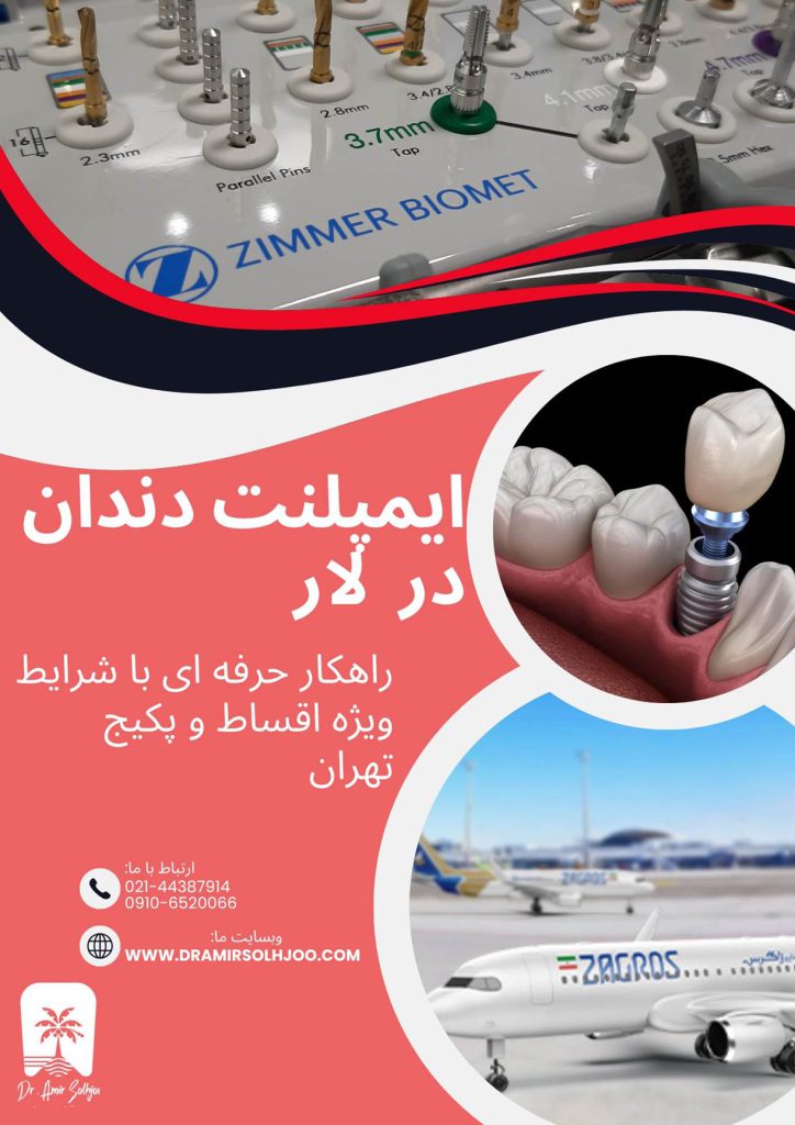 ایمپلنت دندان در شهر لار