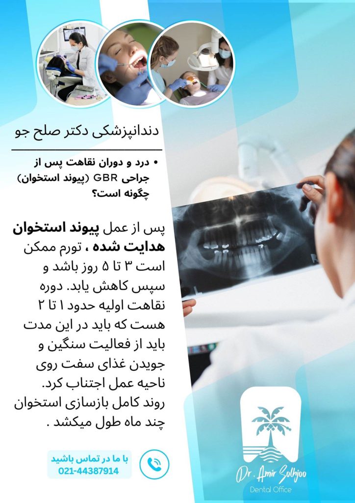 پیوند استخوان هدایتشده (GBR)
