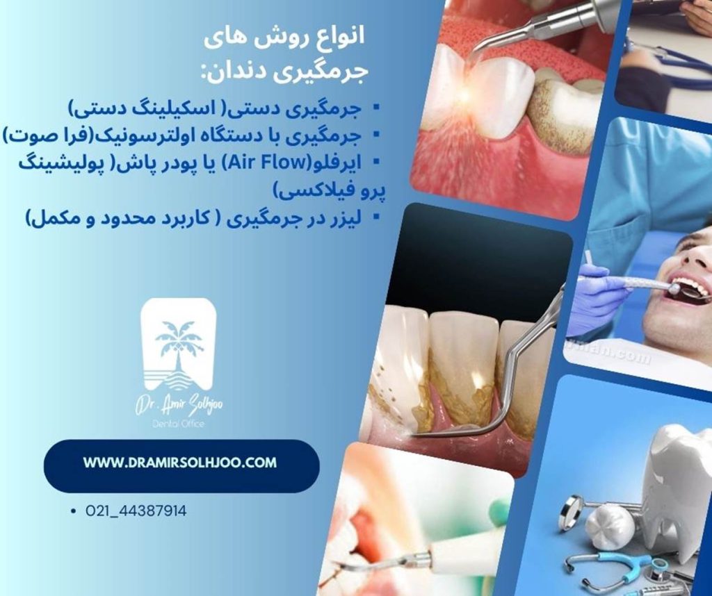 انواع روش های جرمگیری دندان