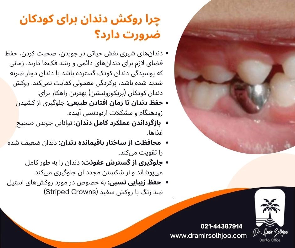 هزینه روکش دندان کودکان