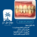 جرمگیری دندان خانگی