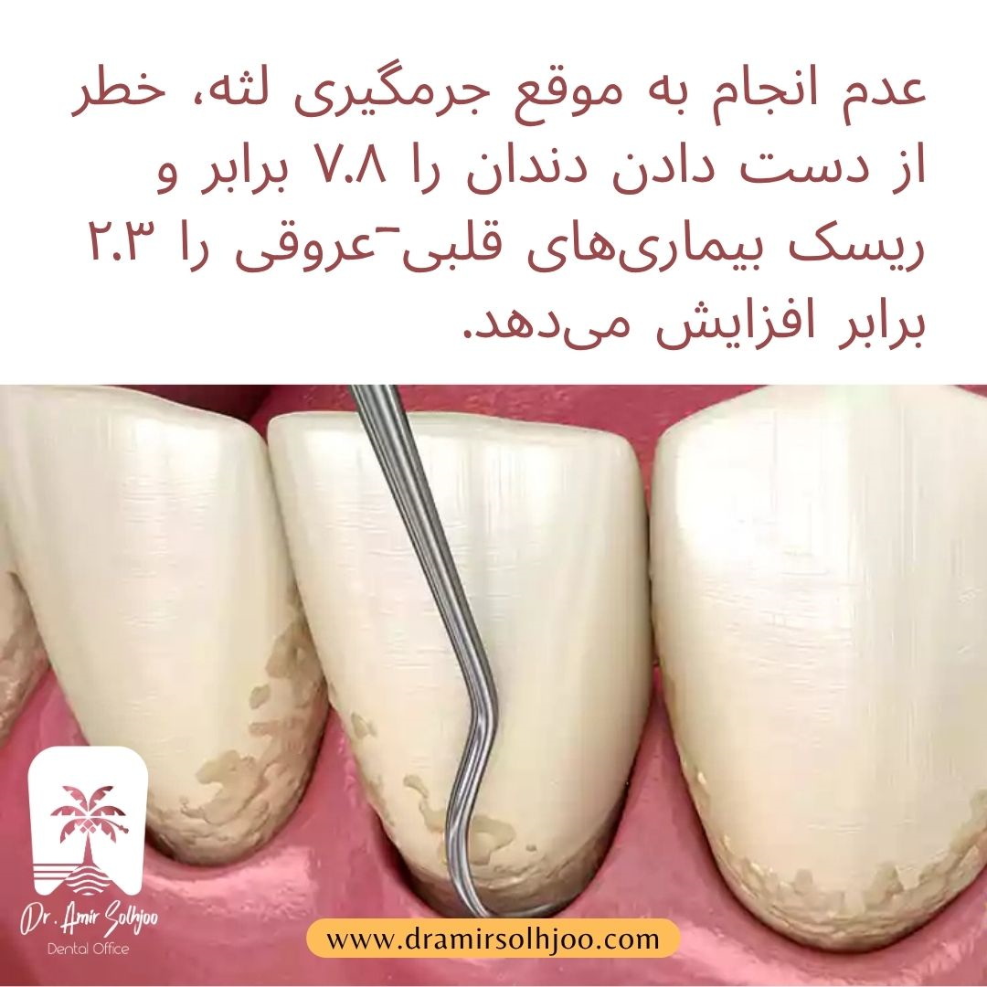 جرمگیری لثه
