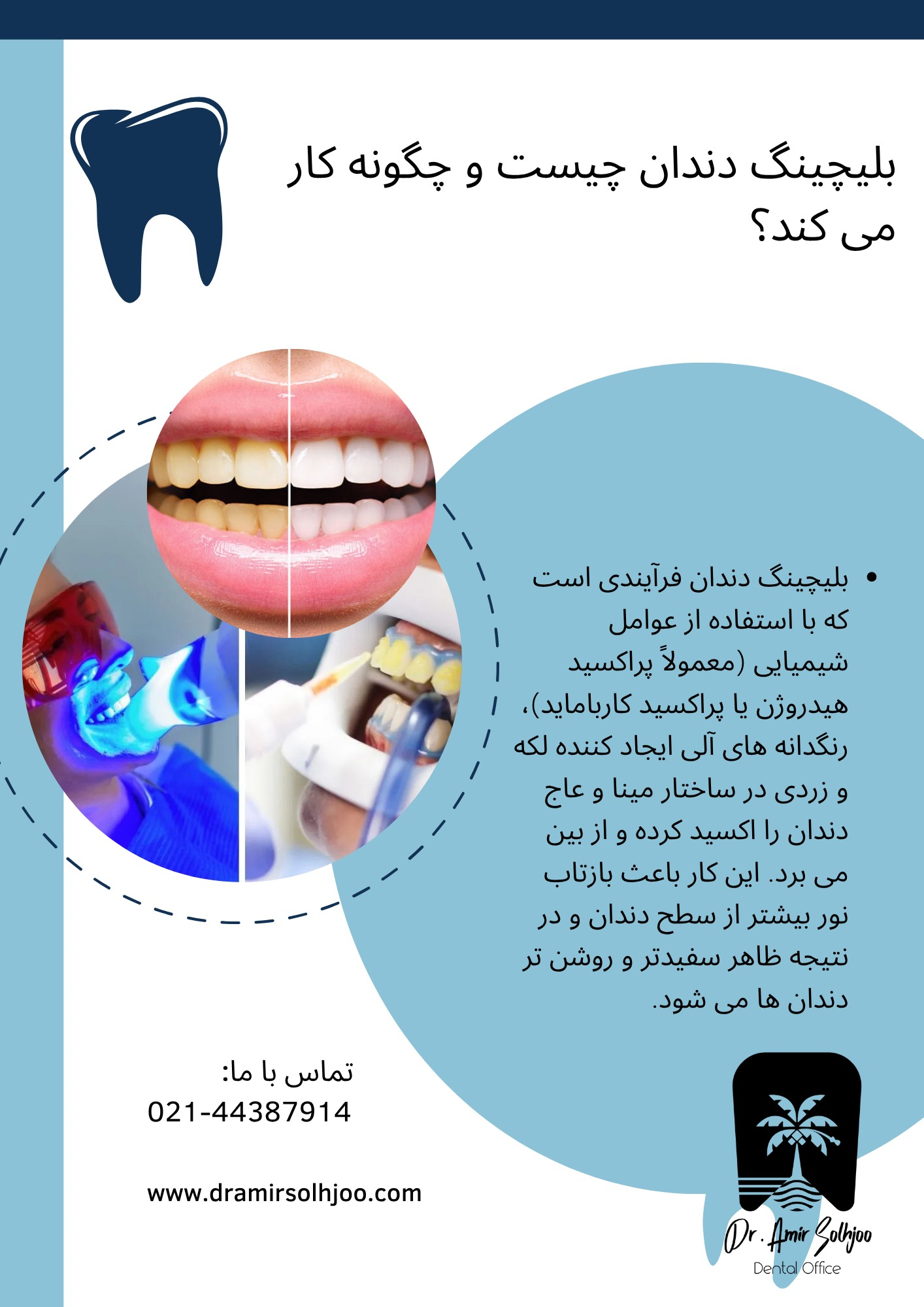 بلیچینگ در مرزداران