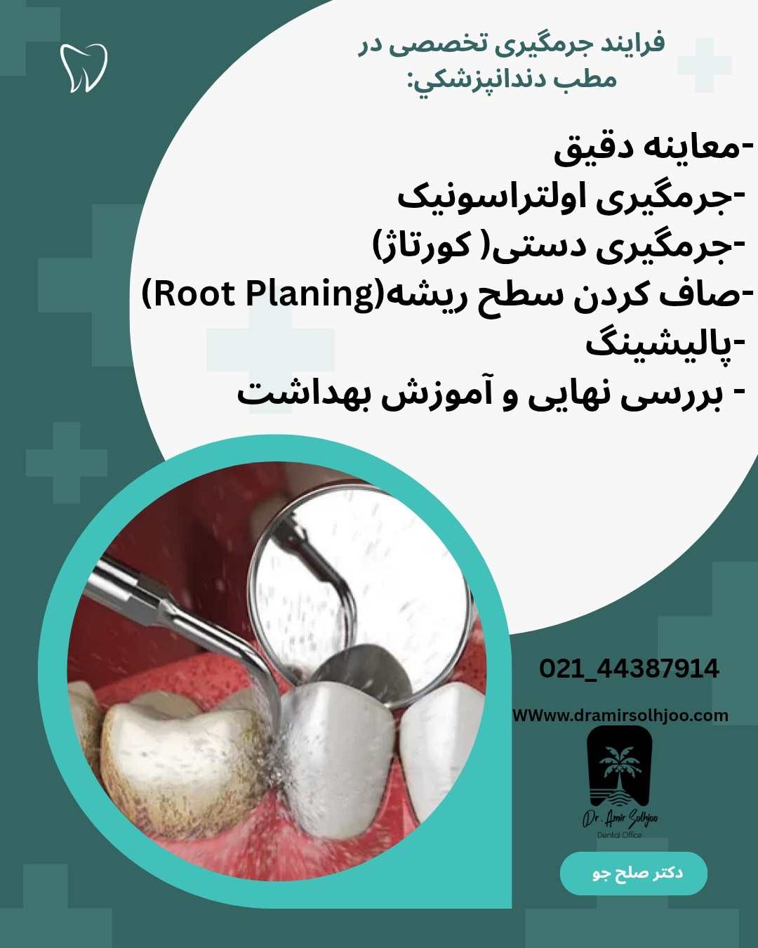 انواع جرم دندان
