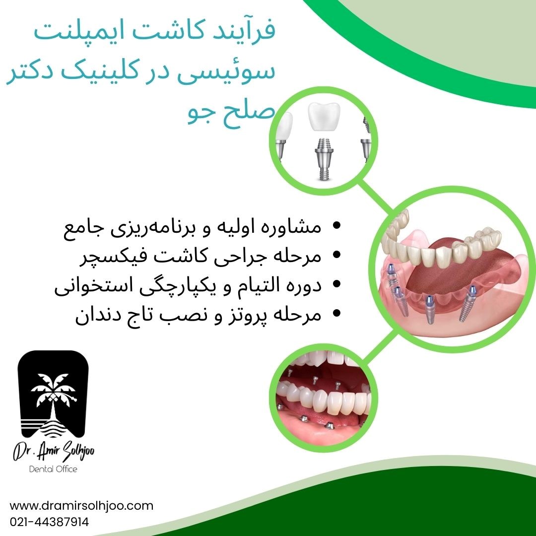 ایمپلنت سوئیسی