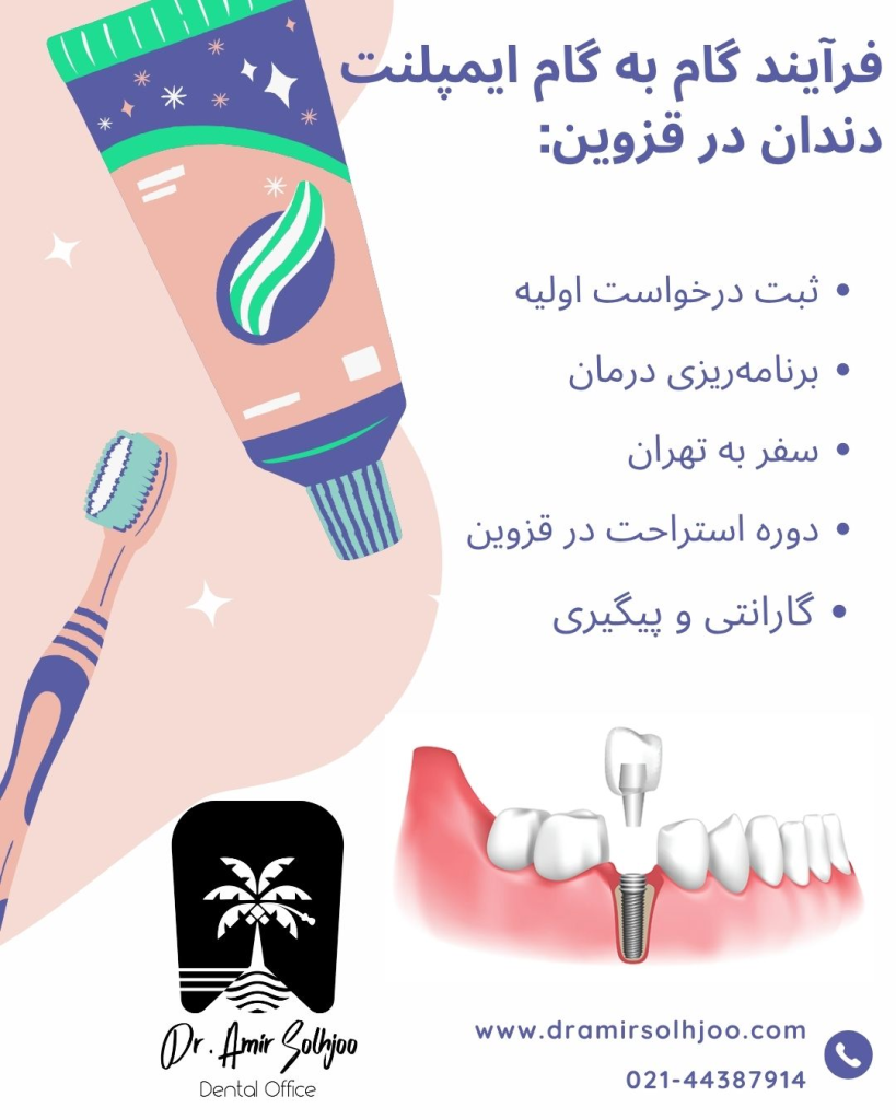 بهترین مرکز ایمپلنت دندان در قزوین