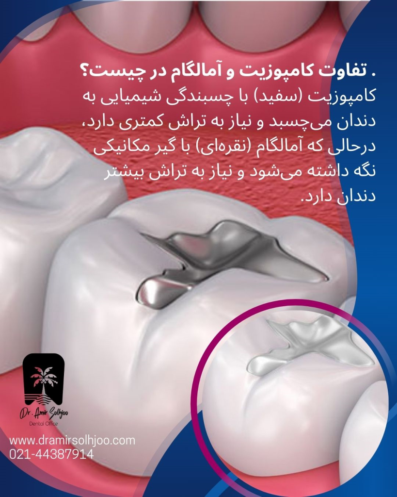 تفاوت کامپوزیت و آمالگام