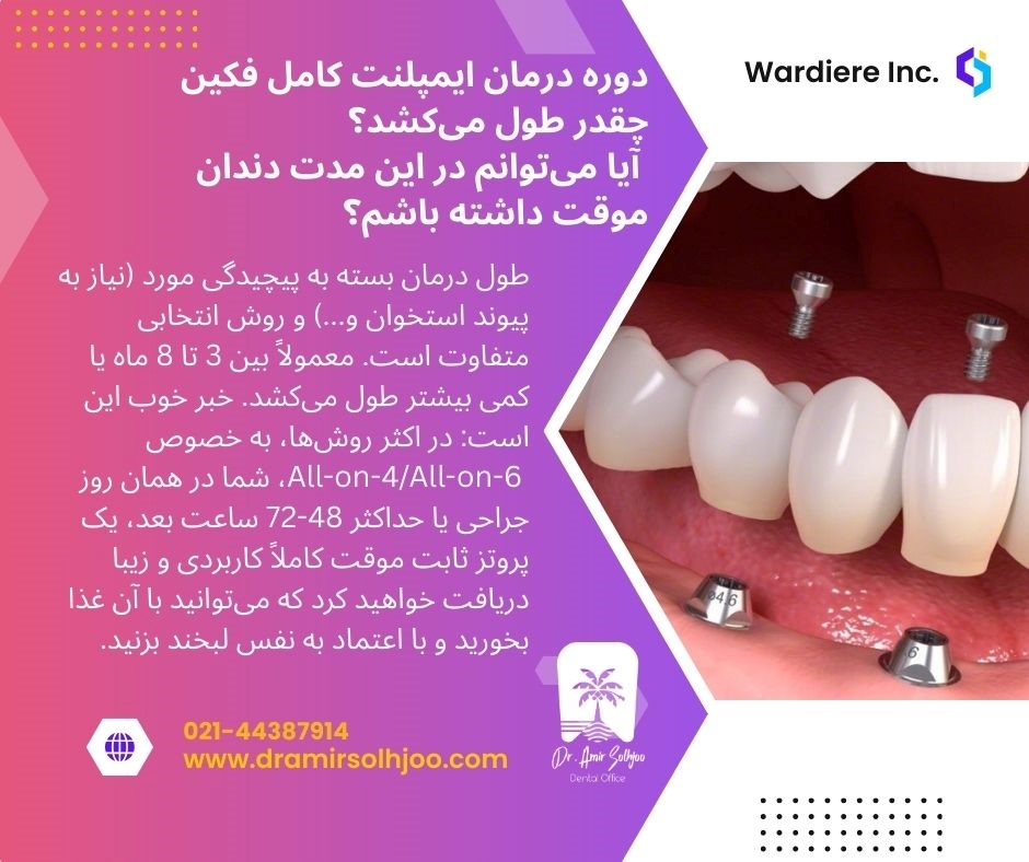 طول درمان ایمپلنت کامل فک بالا و پایین