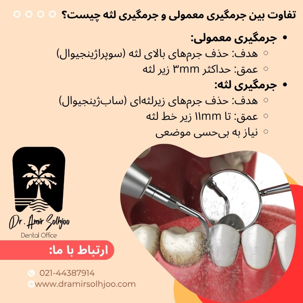 جرمگیری لثه