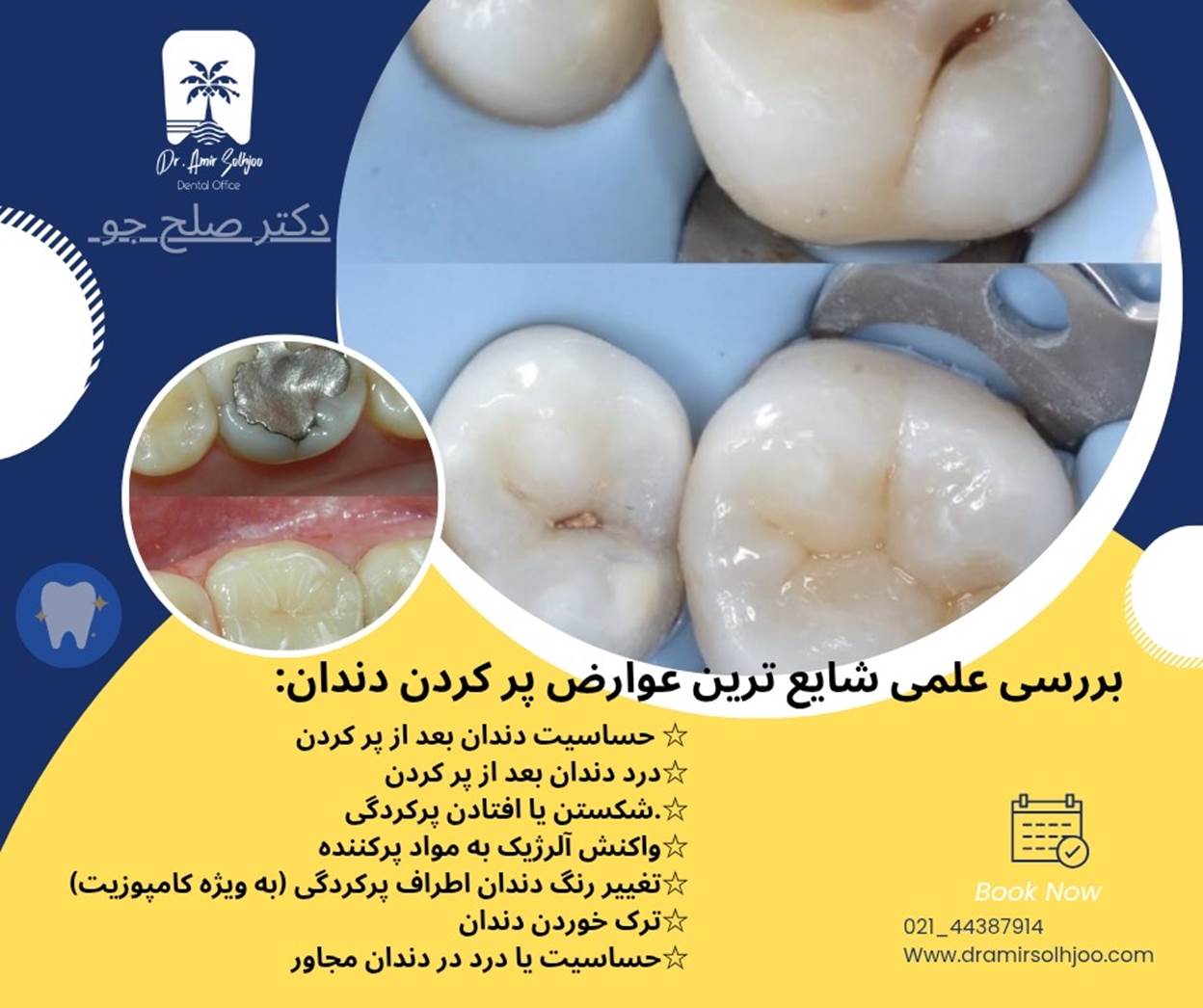 عوارض پر کردن دندان