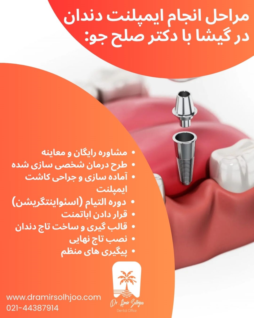 بهترین مرکز ایمپلنت دندان در گیشا