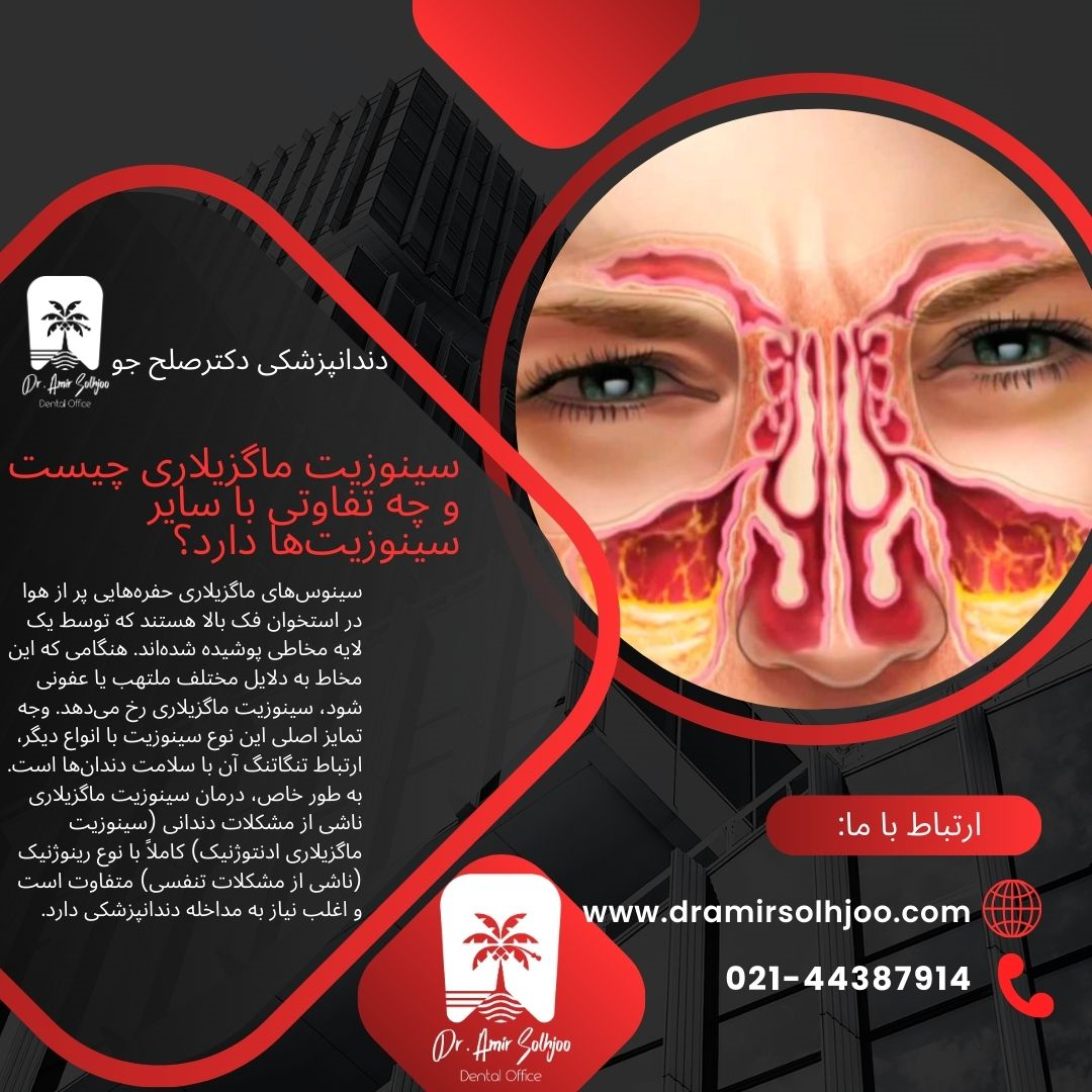 درمان سینوزیت ماگزیلاری