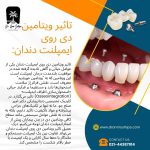 تاثیر ویتامین دی روی ایمپلنت دندان