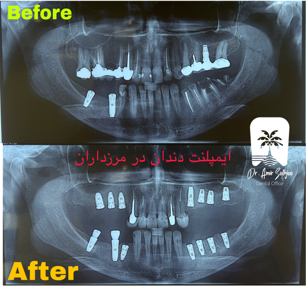نمونه کار ایمپلنت دندان
