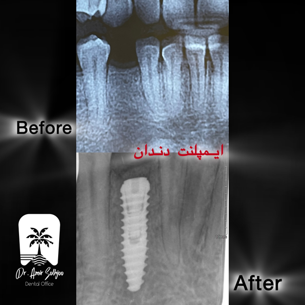 نمونه ایمپلنت دندان در نارمک