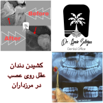 کشیدن دندان عقل در صادقیه
