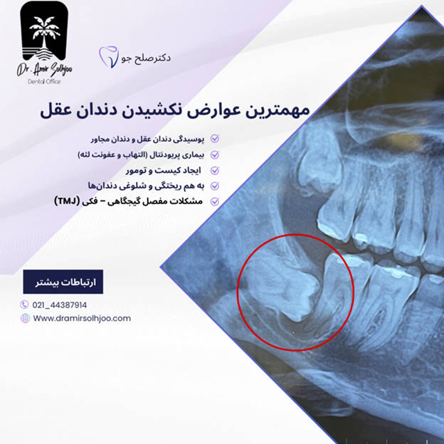 عوارض نکشیدن دندان عقل