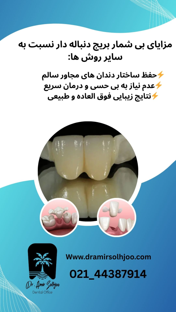 مزایای بریج دنباله دار