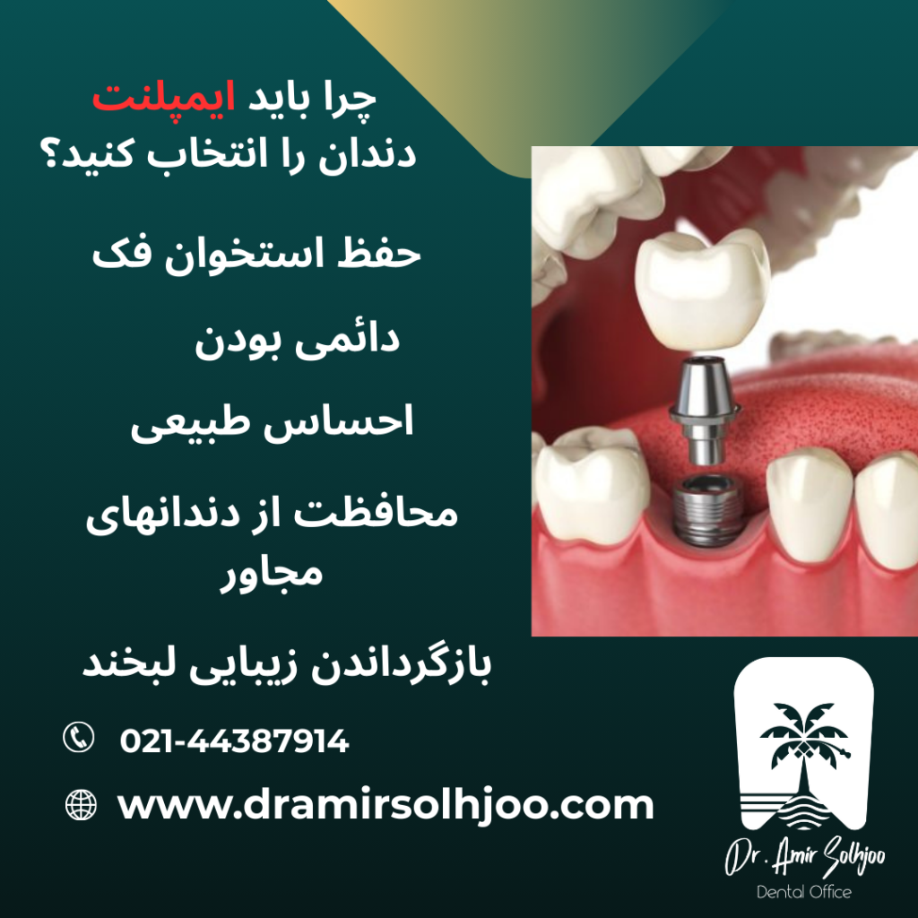 ایمپلنت دندان در شهر آرا