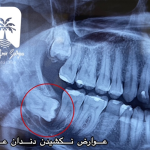 عوارض نکشیدن دندان عقل