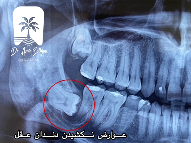 عوارض نکشیدن دندان عقل